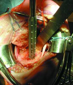 Two retractors are placed behind the shaft and the intramedullary canal is debrided of hematoma and any bony debris.