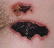 Clinicians require an understanding of the range of modern wound dressings that are currently available.
