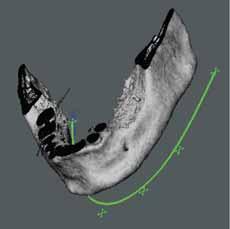 Figure 2: Software planning sequence, implant placement. Figure 2a: Lateral view, posterior mandible.