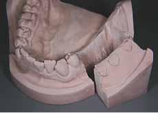 Figure 4: Reconstitution of master cast from the surgical template. Figure 4a: Duplicate master cast with residual ridge area removed.
