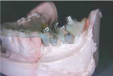 A surgical occlusal index is prepared using a heavy bodied silicone rubber material. This index is important for template stabilization in the first step of the surgical protocol.