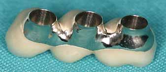Figure 5: Retrievable prosthetic solution for Teeth-in-an-Hour