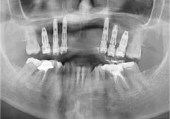 Accuracy of the method The overall total error in dental implant guided surgery is an accumulation of the errors inherent not only to the reformatting of CT scan, software manipulations and template