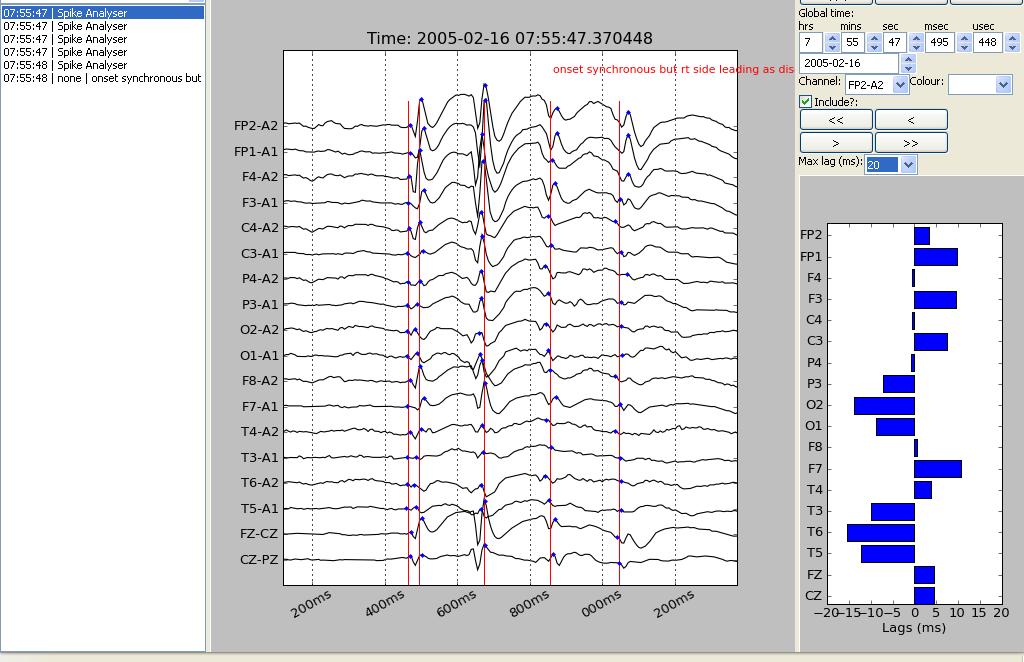 Chapter 3 Methods 102 2 1 3 4 Figure 3.4. Spike analysis using Electrow software. Shows a generalised discharge, which appears synchronous at onset.