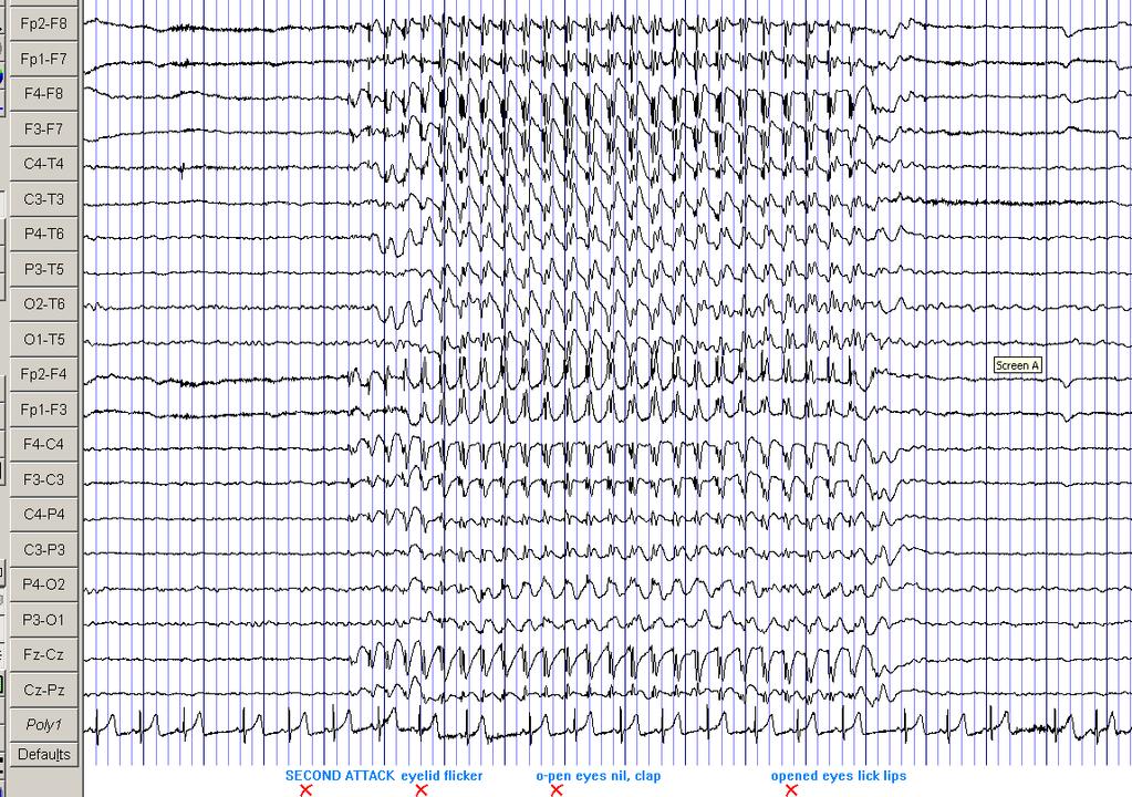 Chapter 4 Results 109 Figure 4.3. EEG of a 7 year old boy with IGE during an absence attack.