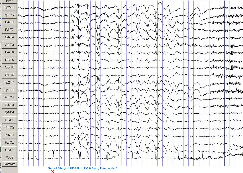 Chapter 4 Results 110 Figure 4.4. EEG of a 28 year old woman with IGE, showing a GSW+PSW discharge.