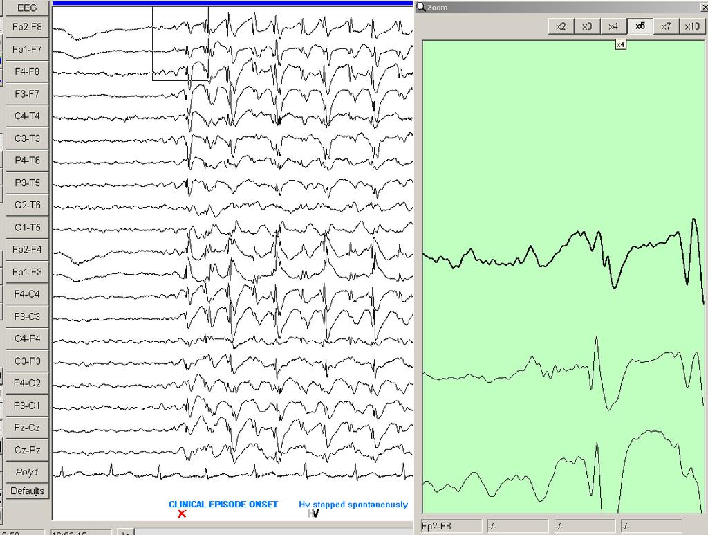 Chapter 4 Results 115 1 2 Figure 4.7. EEG shows a generalized discharge in a 13 year old girl with IGE during an absence attack.