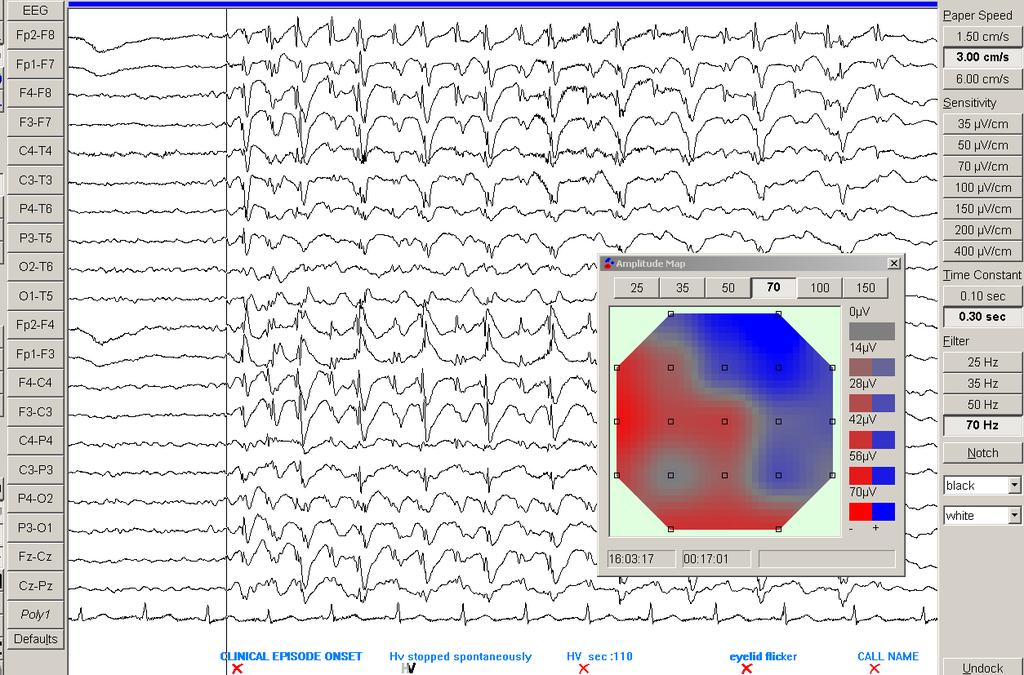 Chapter 4 Results 118 Figure 4.8. EEG of 13 year old with IGE during an absence.