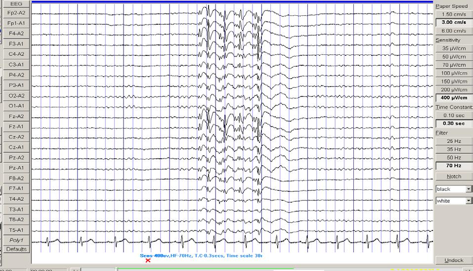 Chapter 4 Results 119 Figure 4.9. Example of a generalized poly spikes and wave discharge in a 34 year old man with juvenile absence epilepsy.