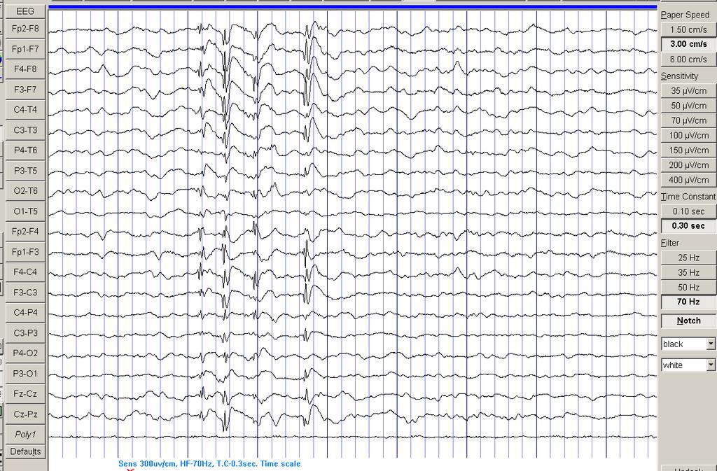 Chapter 4 Results 122 Figure 4.12. EEG of a 13 year old boy with IGE showing a generalised polyspike-and-wave discharge maximal frontally.
