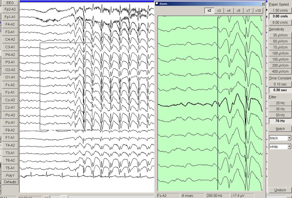 Chapter 4 Results 128 1 2 Figure 4.18. EEG of a 6 year old boy with childhood absence epilepsy. The generalised discharge is synchronous at onset.