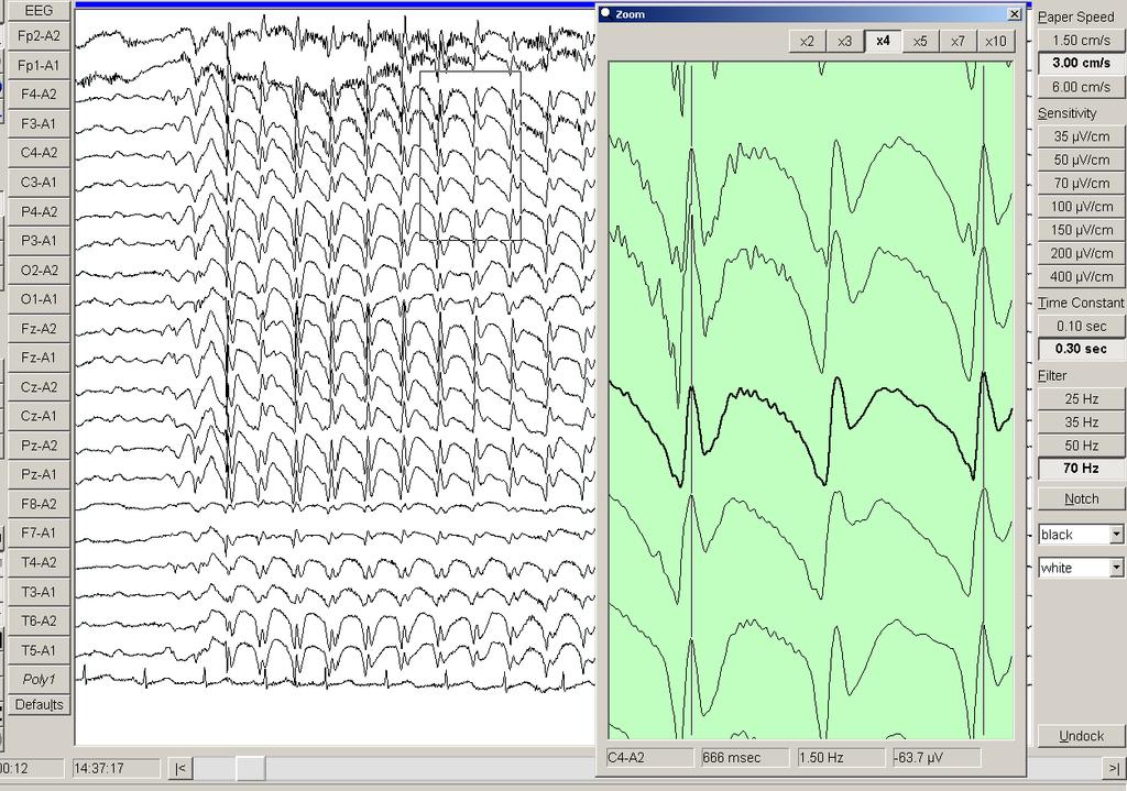 Chapter 4 Results 129 2 1 Figure 4.19. EEG of a 6 year old boy with childhood absence epilepsy.