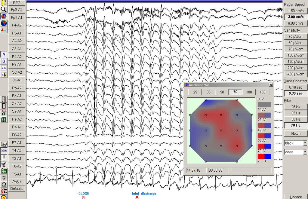 Chapter 4 Results 130 Figure 4.20. EEG of a 6 yr old boy with CAE.