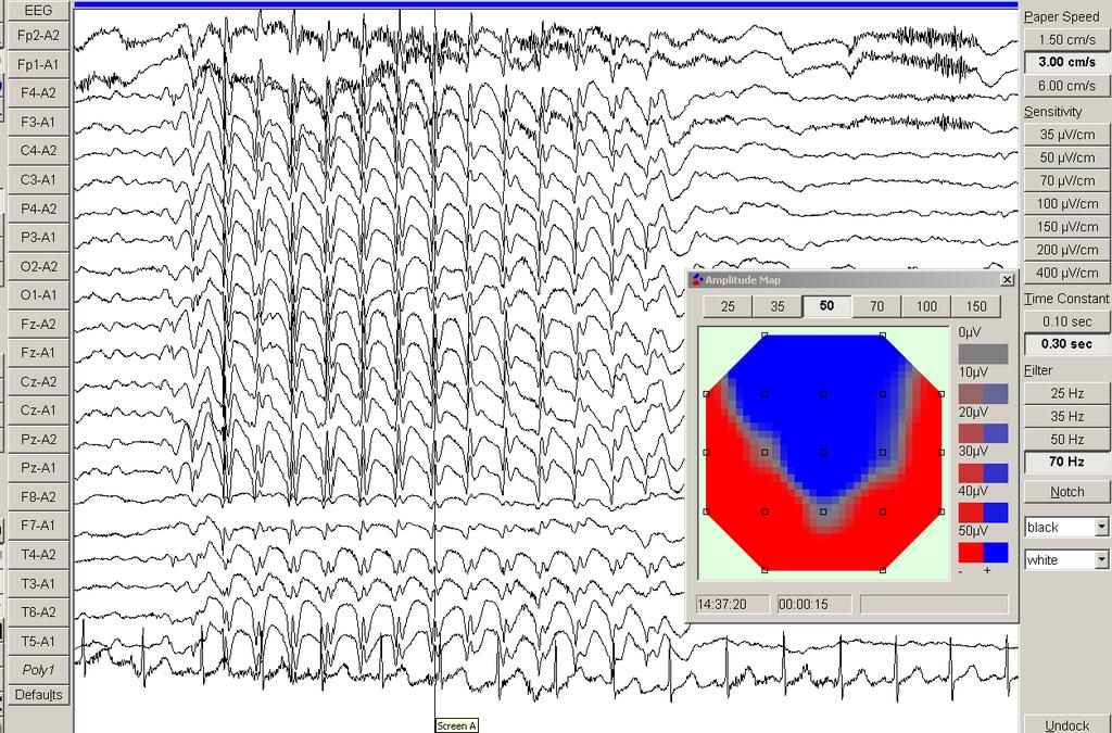 Chapter 4 Results 131 Figure 4.21. EEG of a 6 year old boy with childhood absence epilepsy.