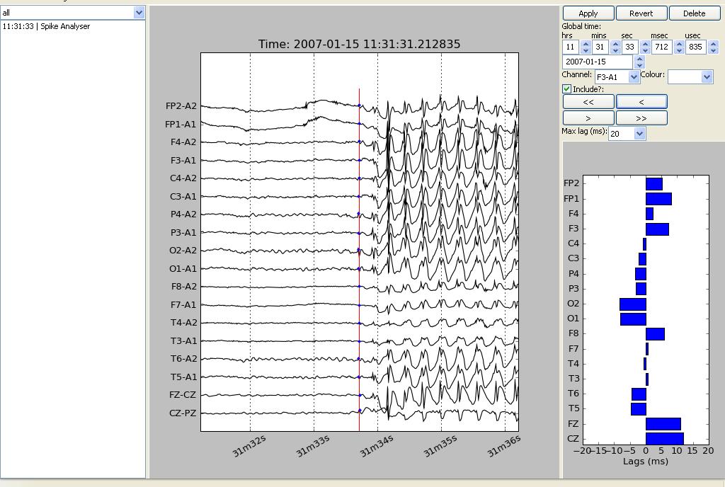 Chapter 4 Results 132 3 2 1 Figure 4.22. Electrow spike analysis of a generalised discharge onset in a 10 year old girl with CAE.