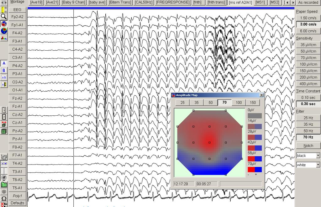 Chapter 4 Results 133 Figure 4.23. EEG of a 10 year old girl with CAE.