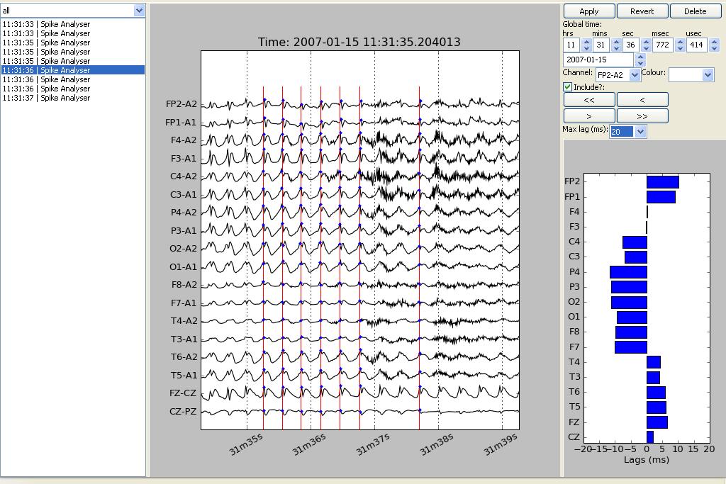 Chapter 4 Results 134 4 1 7 Figure 4.24. Spike analysis result of a generalised synchronous discharge. Shows the same generalised as in figure 4.23 synchronous at propagates.