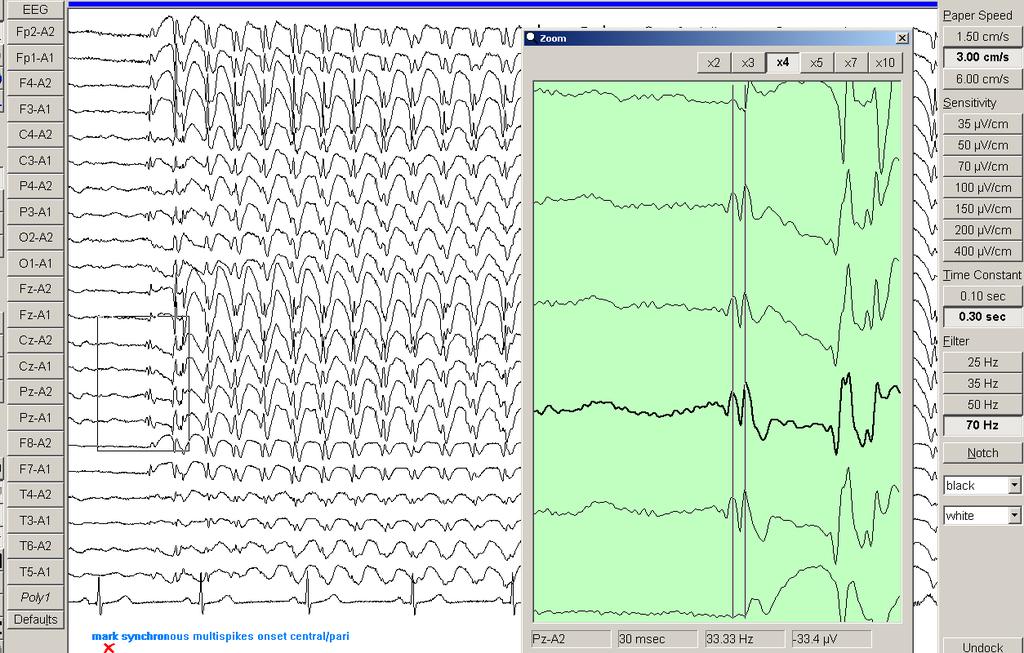 Chapter 4 Results 136 Figure 4.26. EEG shows a generalised discharge in a 15 year old girl with IGE. The discharge onset with a double spike in the midline regions CZ, PZ.
