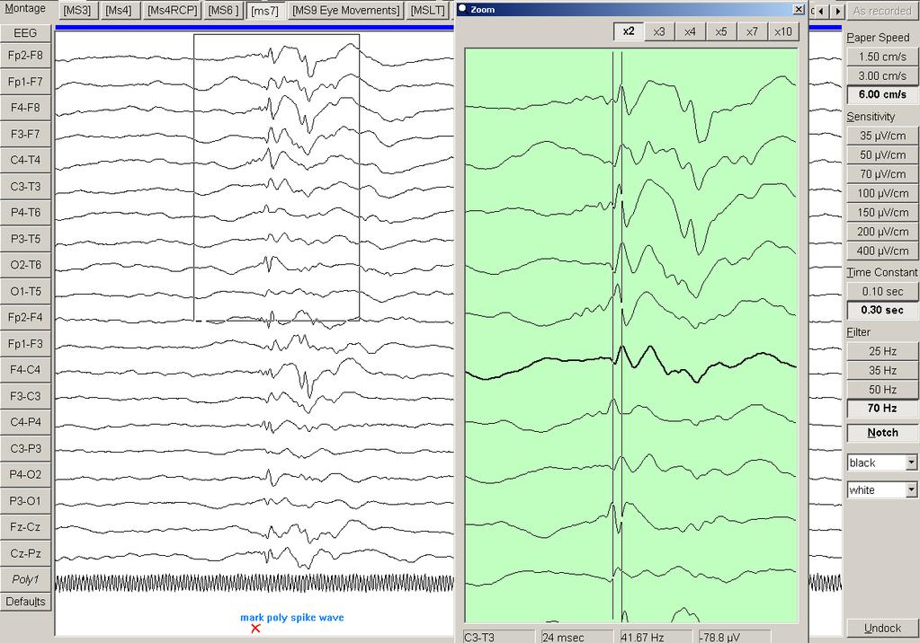 Chapter 4 Results 137 R R l R R l Figure 4.27. EEG shows an interictal discharge of a 15 year old boy with IGE during sleep.