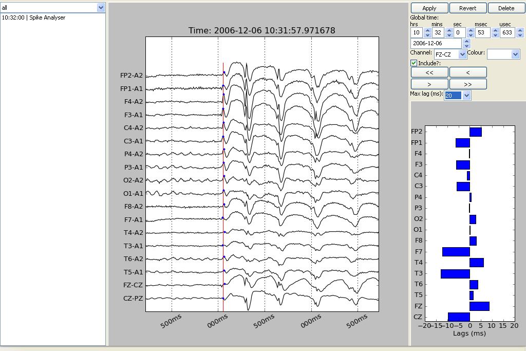 Chapter 4 Results 139 Figure. 4.28.1. Electrow analysis shows the same generalised discharge in a 30yr old with woman with IGEs as in figure 4.28. At discharge onset, the left hemisphere leads the right as displayed in the lag time map zoom window.