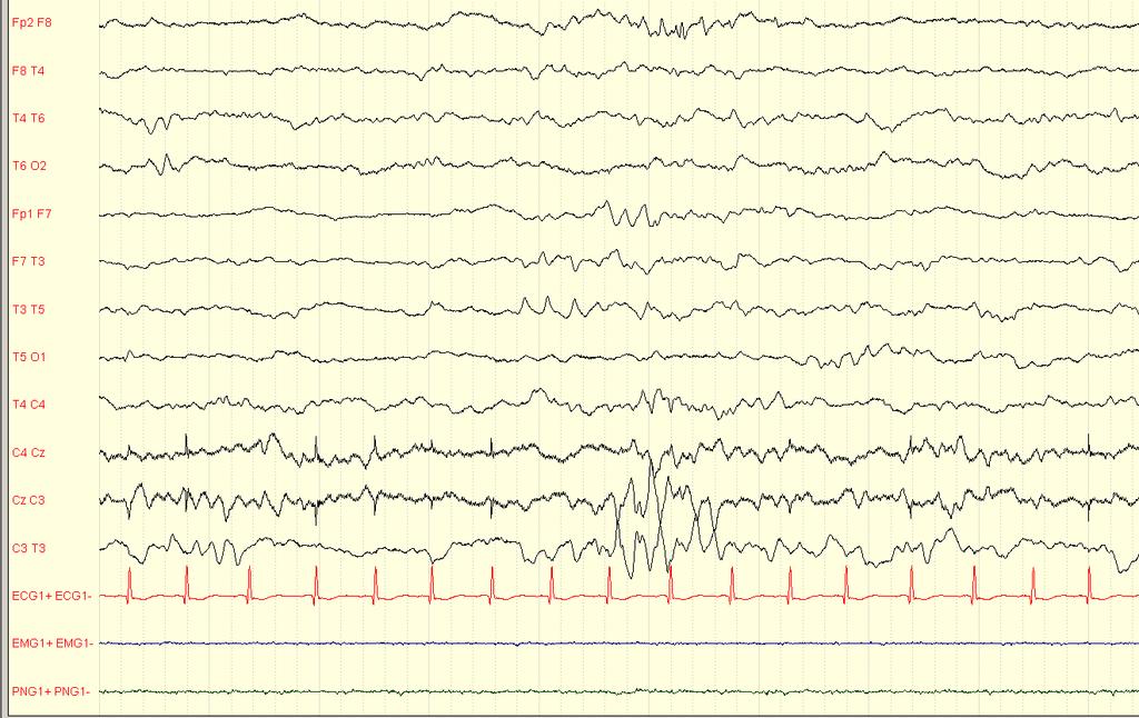 Chapter 1 Introduction 23 1 Figure A. EEG of a full-term 3 day old baby with neonatal seizures during day one after a normal birth. Seizures occurred every few hours, lasting approximately 20 minutes.