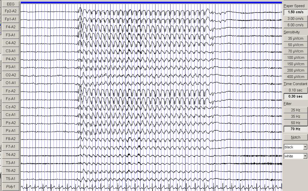 Chapter 1 Introduction 28 Figure B: Generalised discharge in CAE. The EEG shows a 3 Hz generalized spike-andwave discharge in a 10yr old girl with absence seizures. Sens-500μV/cm, HF-70Hz, TC-0.