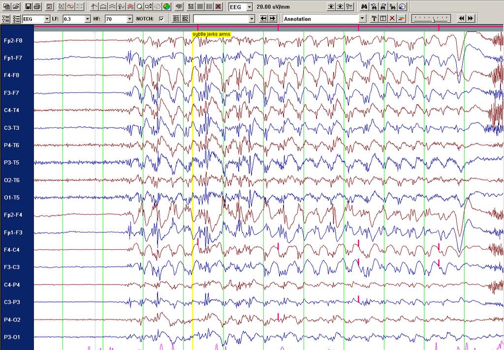 Chapter 1 Introduction 33 Figure C. EEG of a woman with JME. The EEG shows a generalized polyspike-andwave discharge in a 22yr old woman with JME. The clinical seizures were mainly myoclonic jerks.