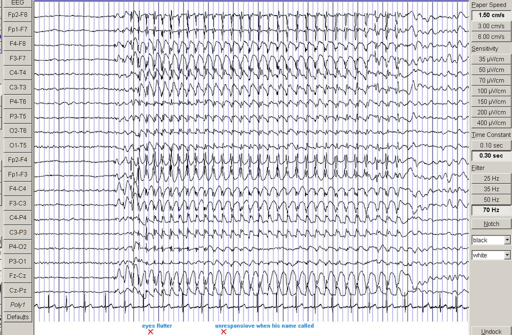Chapter 1 Introduction 35 Figure D: EEG of a 10yr old boy with IGE during an absence attack.