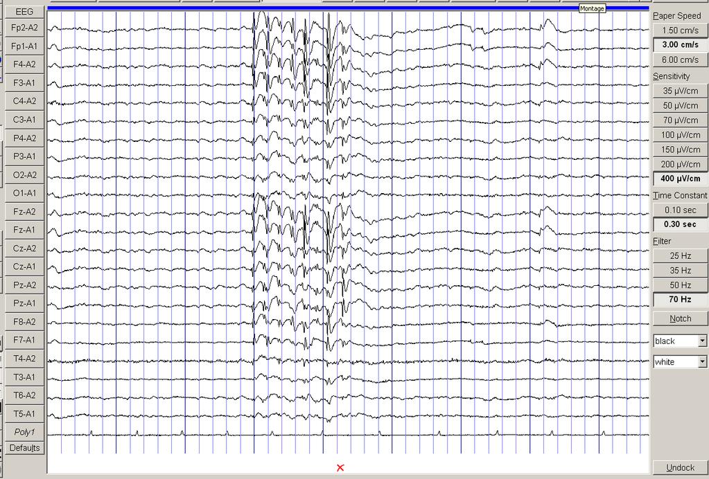 Chapter 1 Introduction 36 Figure E. EEG of 26yr old man with IGE who presented with GTCS only during various times of the day.