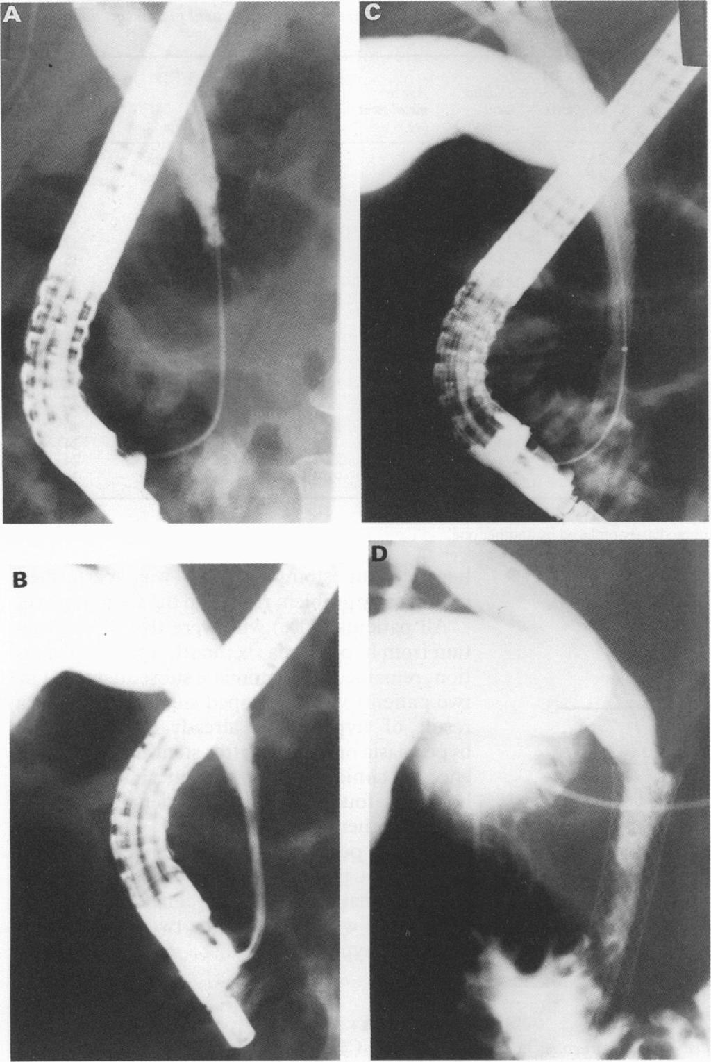 stent is endoscopically and fluoroscopically adjusted; (C) control cholangiography after stent expansion; (D) control endoscopic retrograde cholangiopancreatography 24 months later showing that the