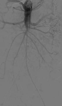 Covered Endovascular Reconstruction of Aortic Bifurcation (CERAB) Technique 9Fr and 7 Fr sheaths into