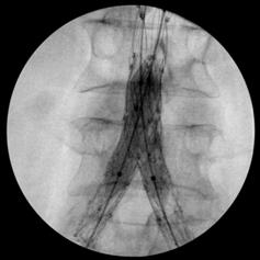 Endologix AFX To Treat Extensive AIOD Total distal aortic occlusion Recanalization from one iliac artery to