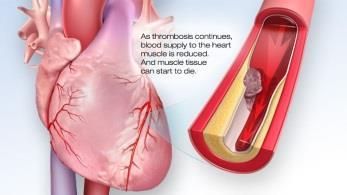 Cardiac Valves damage Blockage of the