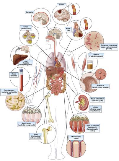 PROPOSED MECHANISMS OF CHRONIC COMPLICATIONS OF PPI