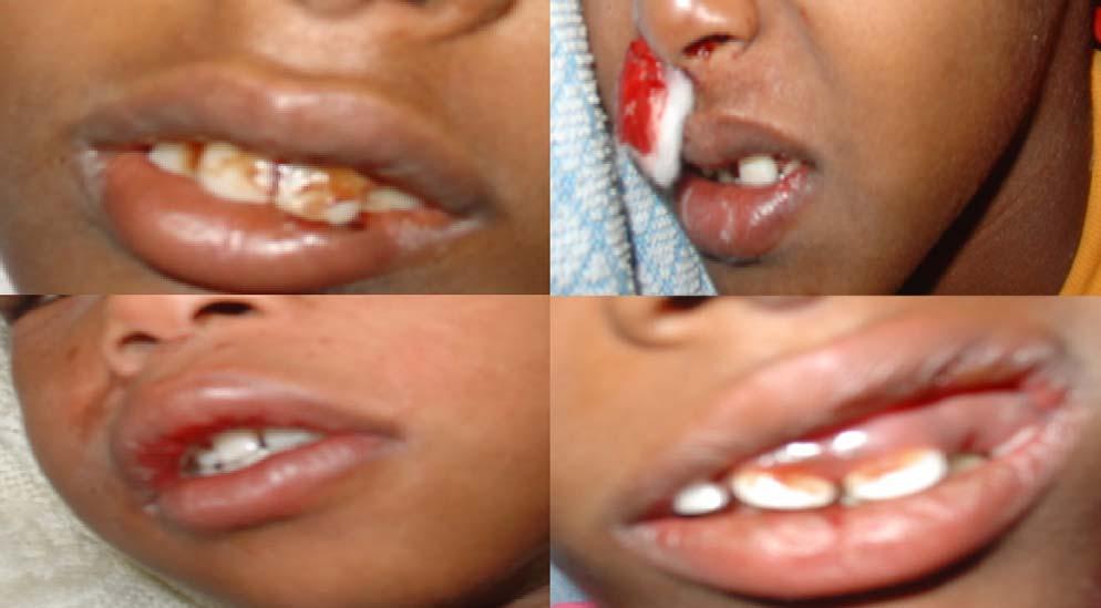 Dengue hemorrhagic fever outbreak in children in Port Sudan 3 Figure 3 Red mouth, gum bleeding, epistaxis and cracked lips.