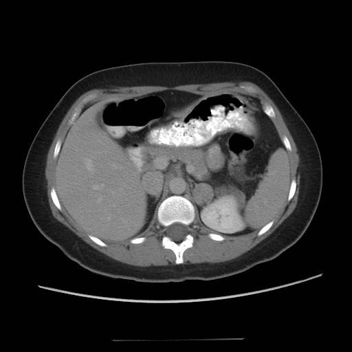 AL - 31yo F w/ abdominal pain CT