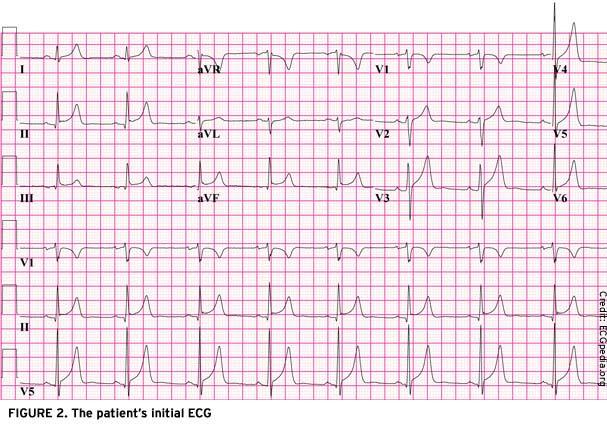 Pericarditis - Print Article JAAPA Page 3 of 4 Is the ECG regular? Yes, the QRS complexes march out. 2. What is the rate? Find a QRS complex on or near a dark line.
