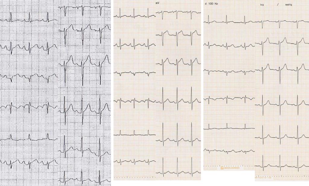 A (First admission) B (Second admission) C (A er treatment) Figure 1. Electrocardiogram (ECG) showing apparent ST-segment elevation in the II, III, and avf leads (A, B).