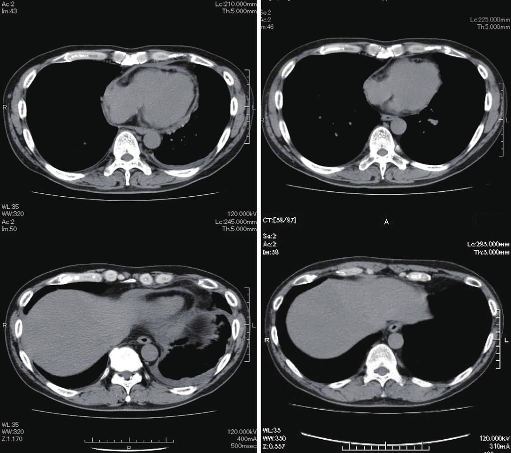 Intern Med 53: 1659-1663, 2014 A (before treatment) B (aōer treatment) Figure 2. Computed tomography of the chest showing mild pericardial effusion and mild left pleural effusion (A).