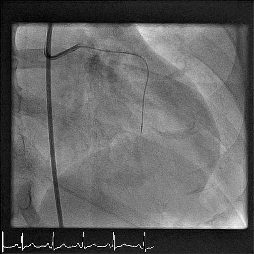 Corsair into the septal with distal tip