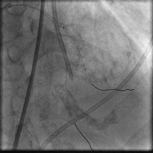 Emergency CABG Proximal vessel injury or side branch Guidewire fracture or