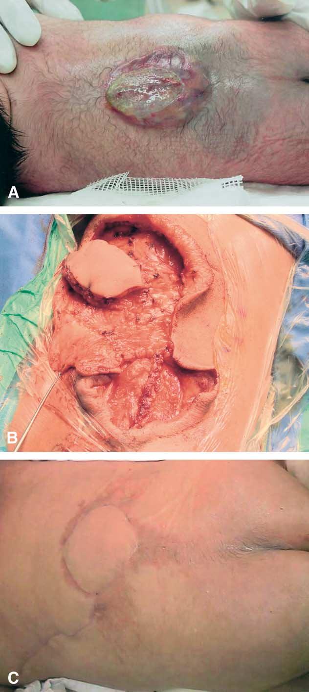Large thoracolumbar meningomyelocele defects 413 Reverse LD muscle flap was reported by Vanderkolk 12 as a case report, and by Scheflan, 13 the blood supply of this flap is also described by