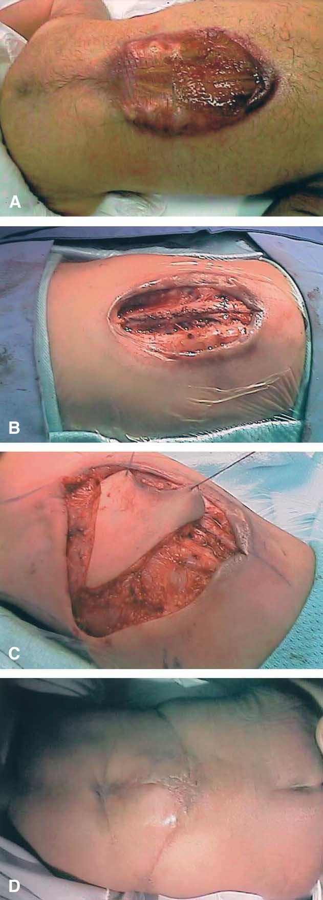 414 H.A. El-khatib Surgical techniques Proximally based LD skin island muscle pedicle flap This flap is indicated to cover large and high-lying defects, which is not distal to the iliac crest.