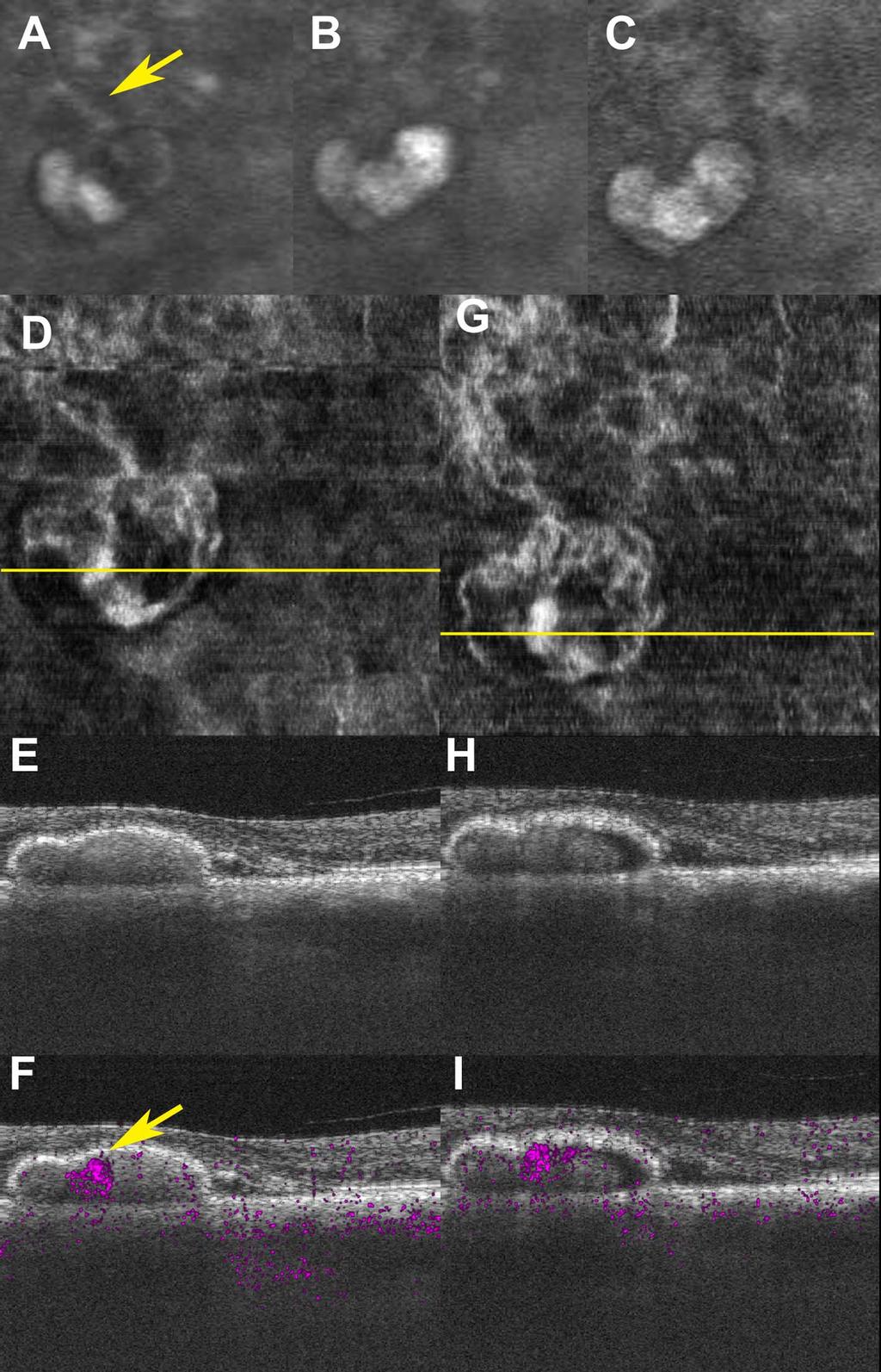 Noninvasive Vascular Imaging of PCV by Doppler OCT IOVS j May 2015 j Vol. 56 j No. 5 j 3181 FIGURE 2.