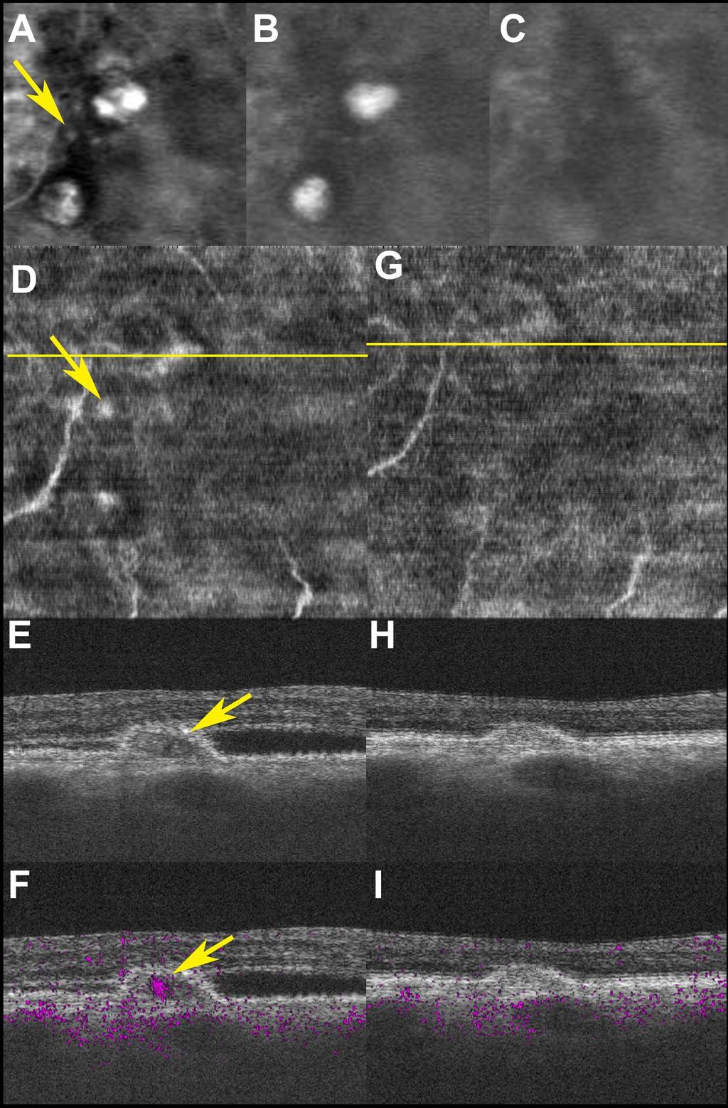 Noninvasive Vascular Imaging of PCV by Doppler OCT IOVS j May 2015 j Vol. 56 j No. 5 j 3182 FIGURE 3.
