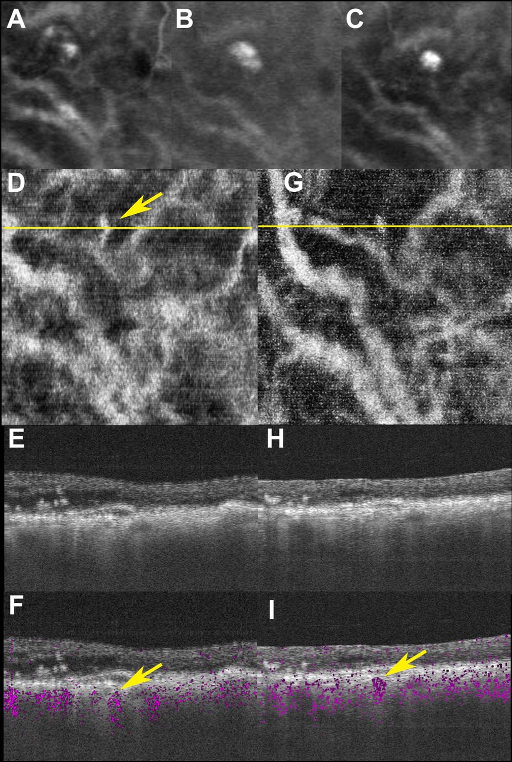 Noninvasive Vascular Imaging of PCV by Doppler OCT IOVS j May 2015 j Vol. 56 j No. 5 j 3183 FIGURE 4.
