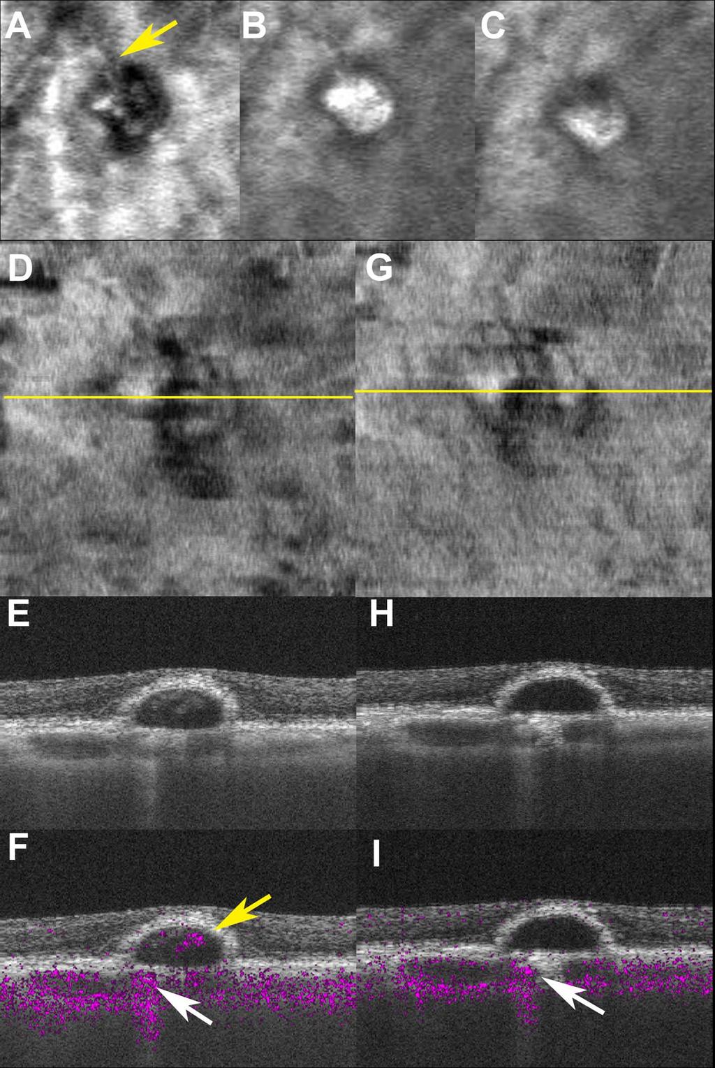Noninvasive Vascular Imaging of PCV by Doppler OCT IOVS j May 2015 j Vol. 56 j No. 5 j 3184 FIGURE 5.