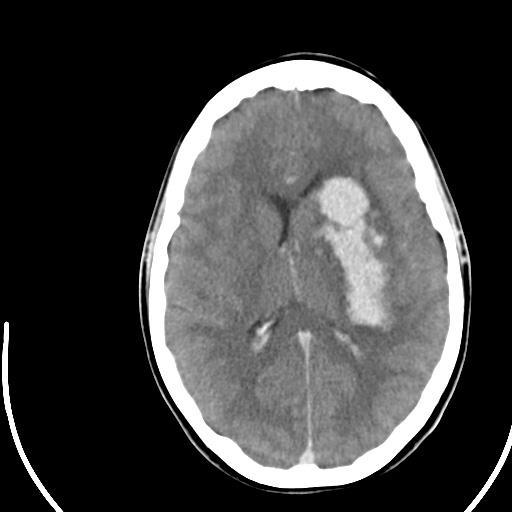Intracerebral haemorrhage Approximately 12-15 per 100,000/year 350