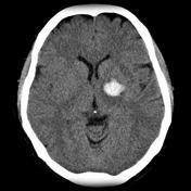 Causes Hypertension Arteriovenous malformation Aneurysmal rupture Cerebral amyloid angiopathy Intracranial neoplasm Coagulopathy Haemorrhagic transformation of