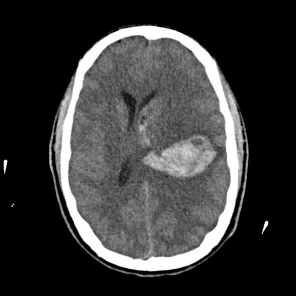 Summary: ICH Anyone with stroke symptoms could have a bleed Early imaging Management of blood